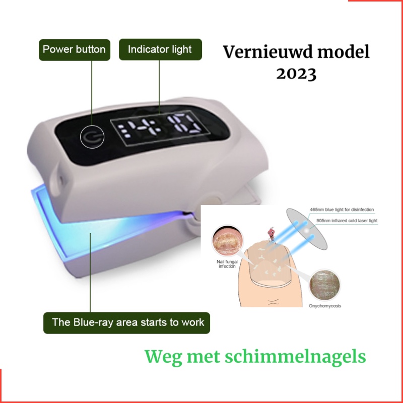 Lasertherapie voor schimmelnagels